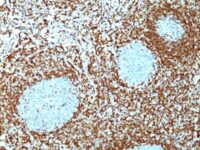 Staining with Mouse Monoclonal BCL-2 [100 D5 + 124] Antibody in formalin-fixed paraffin-embedded human non-Hodgkins Lymphoma. Note cytoplasmic and nuclear membrane staining.